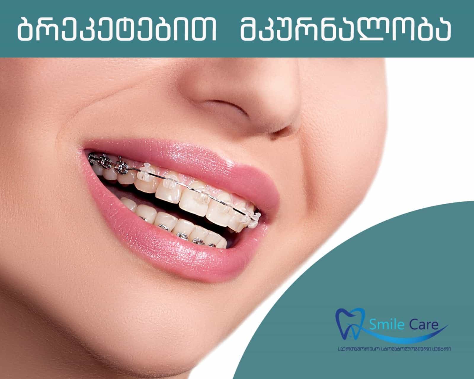 Treatment with braces