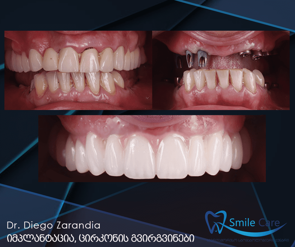 Implantation, zirconium-ceramic crowns.