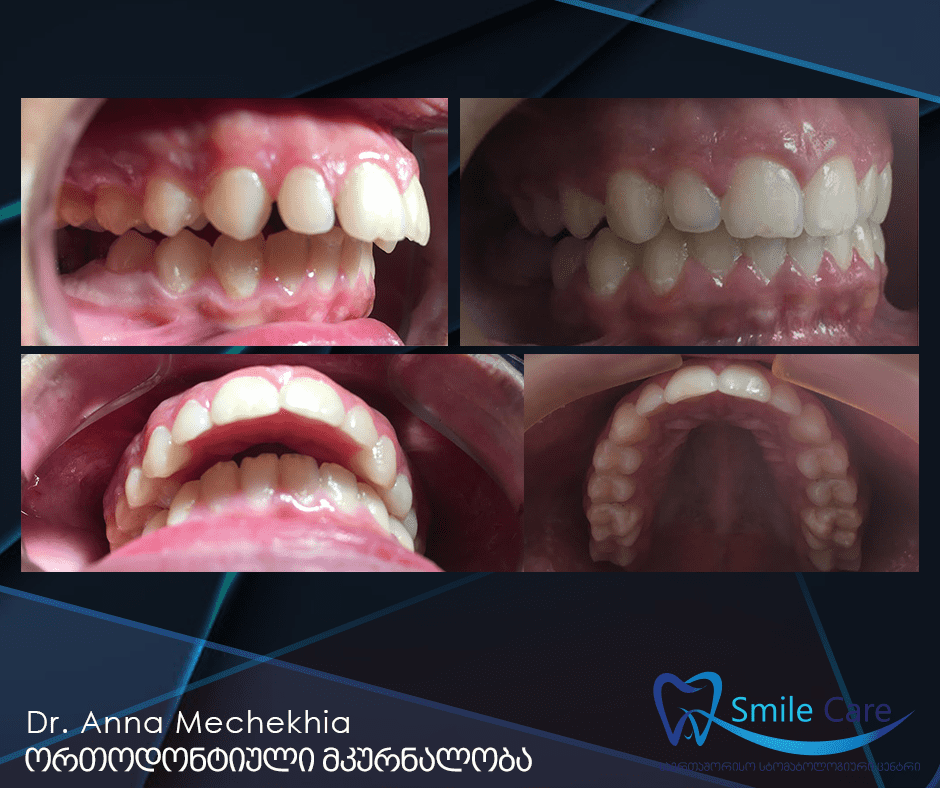Brace-system, removable orthodontic construction